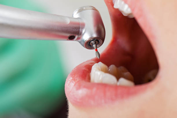 Best Emergency Wisdom Tooth Extraction in Badin, NC